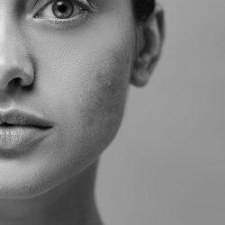 cropped view of girl with problem skin looking at camera isolated on beige