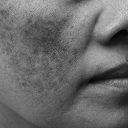 Image before and after spot melasma pigmentation skin facial treatment on face asian woman. Problem skincare and health concept.