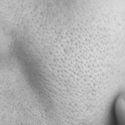 skin texture with enlarged pores. Problem skin. part of a woman face. acne.